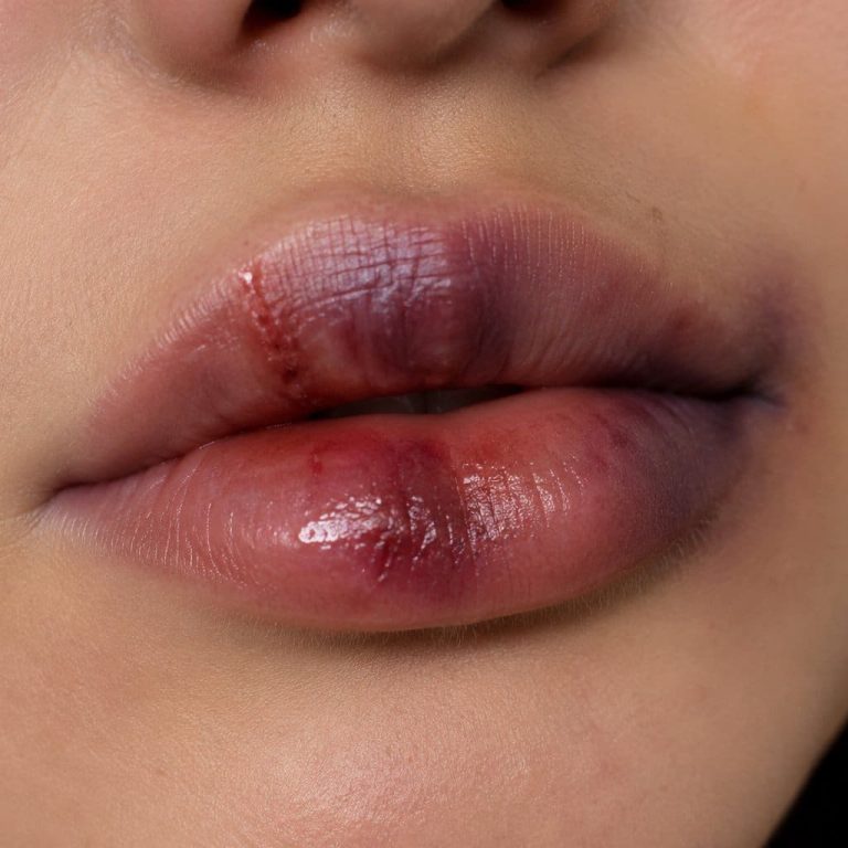 Hematoma visible en labios tras tratamiento con ácido hialurónico, mostrando moratones y suturas.