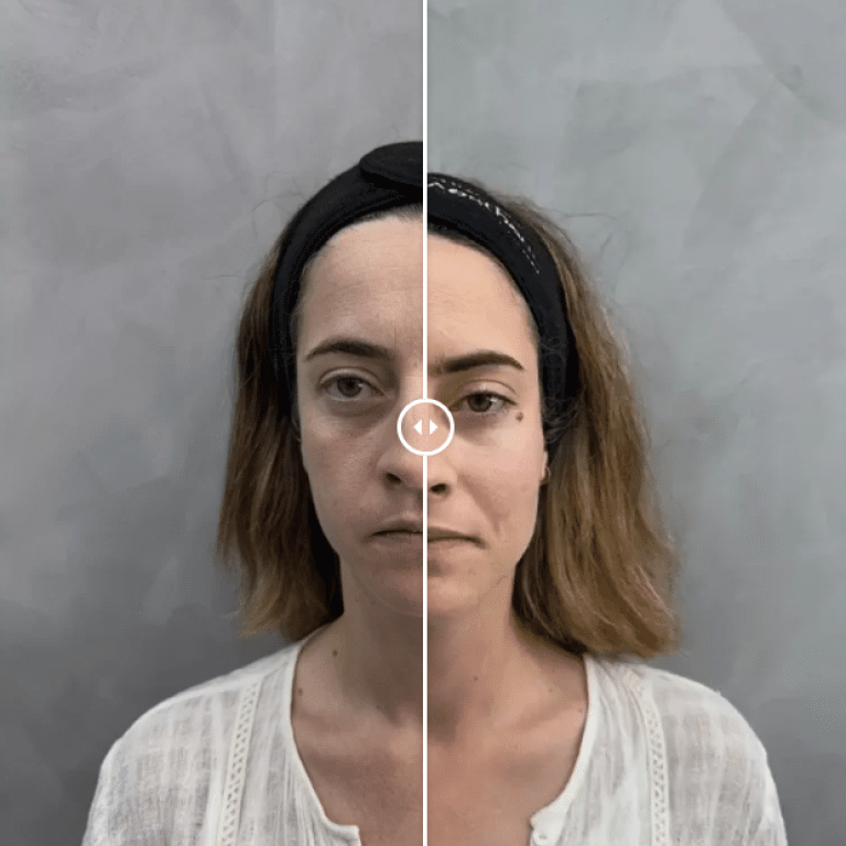 Antes y Después Armonización Facial