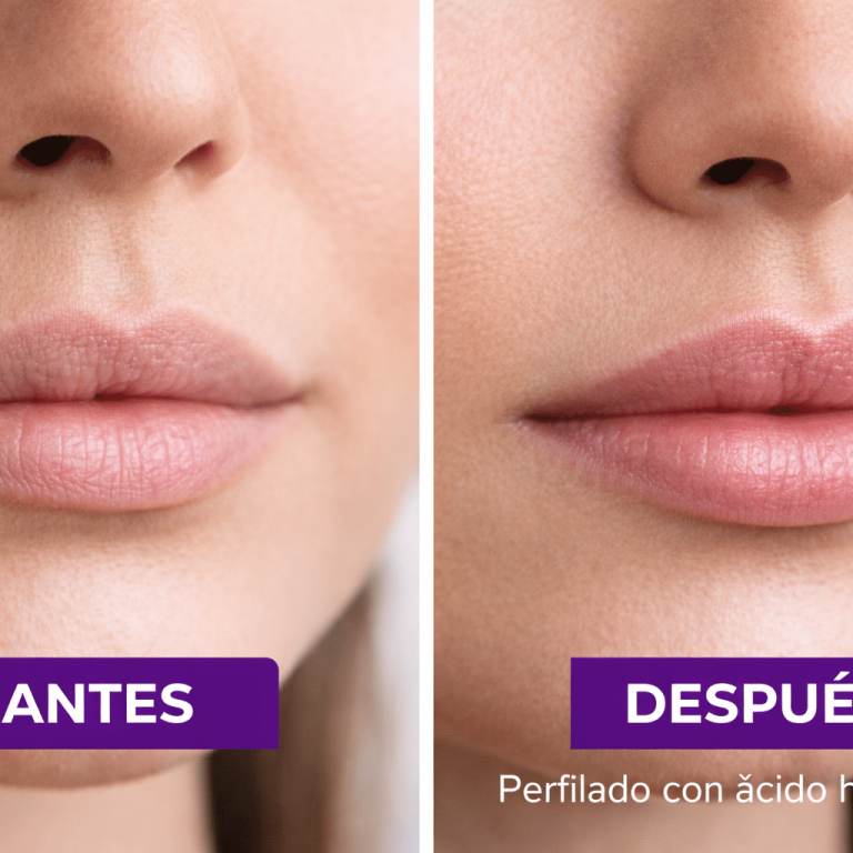 Perfilado de labios con ácido hialurónico: definición y naturalidad sin exceso de volumen