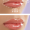 Aumento de labios en Madrid: ¡Consigue los Labios que Deseas en 1 Sesión!