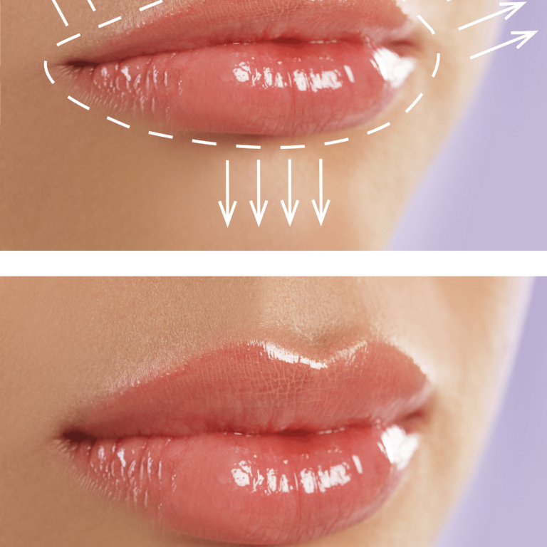 Aumento de labios en Madrid: ¡Consigue los Labios que Deseas en 1 Sesión!