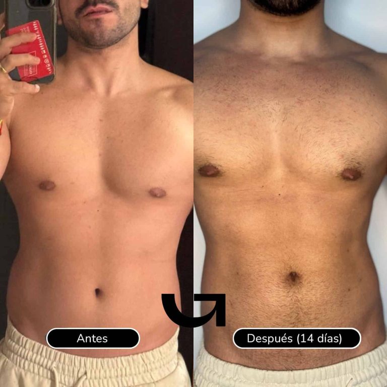 Endolifting Abdominal Antes y Después 2