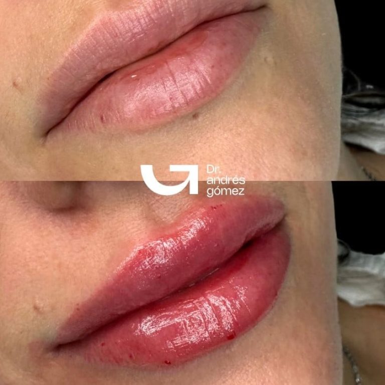 Labios deformados por ácido hialurónico: Causas y cómo solucionarlo