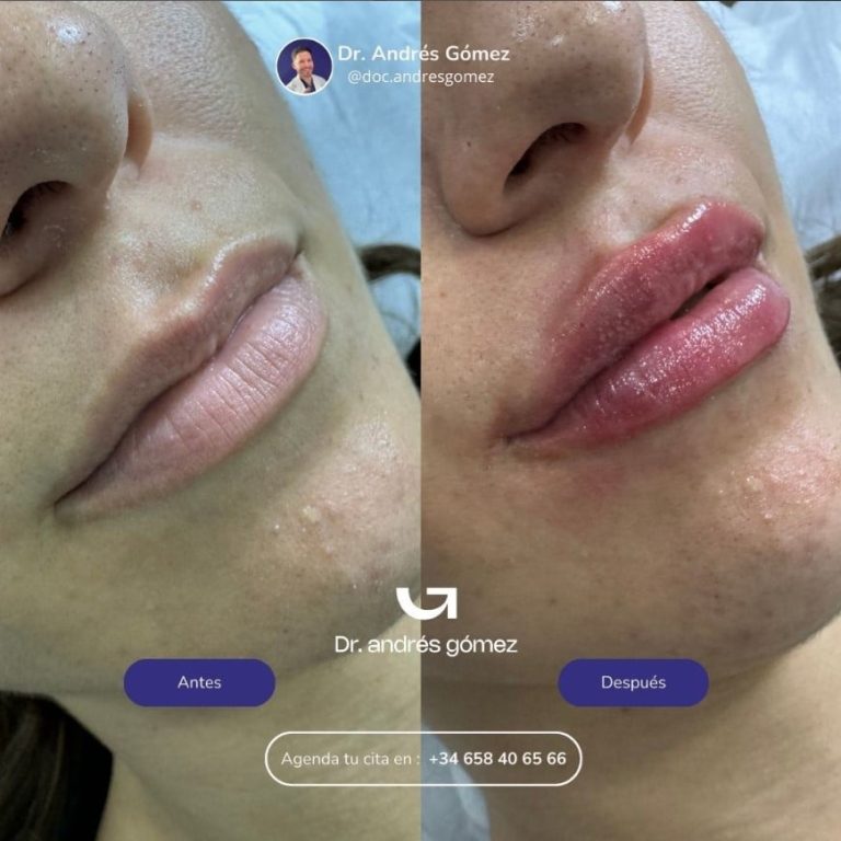 ¿Granuloma en los labios por ácido hialurónico? ¡Soluciónalo!