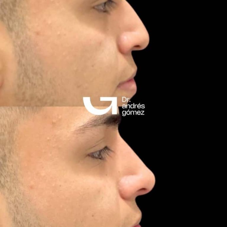Rinomodelación con ácido hialurónico en Madrid
