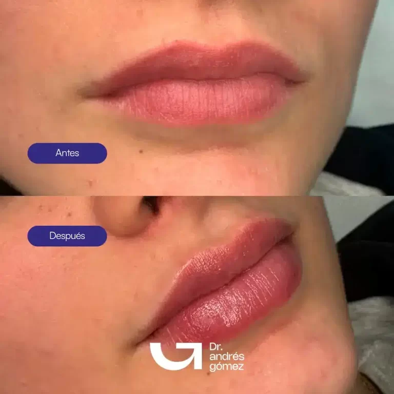 Cómo hidratar los labios después del Ácido Hialurónico: Guía Médica