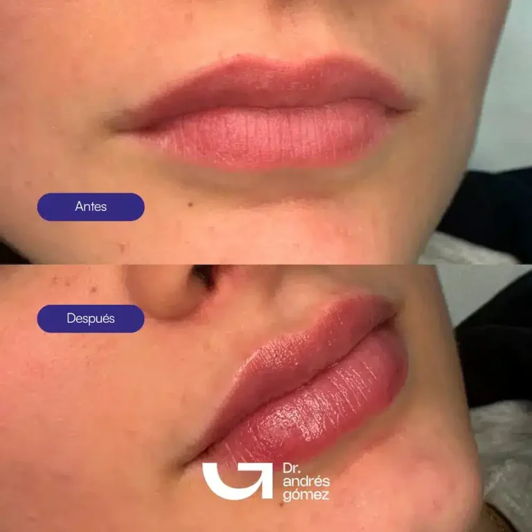 Cómo hidratar los labios después del Ácido Hialurónico: Guía Médica