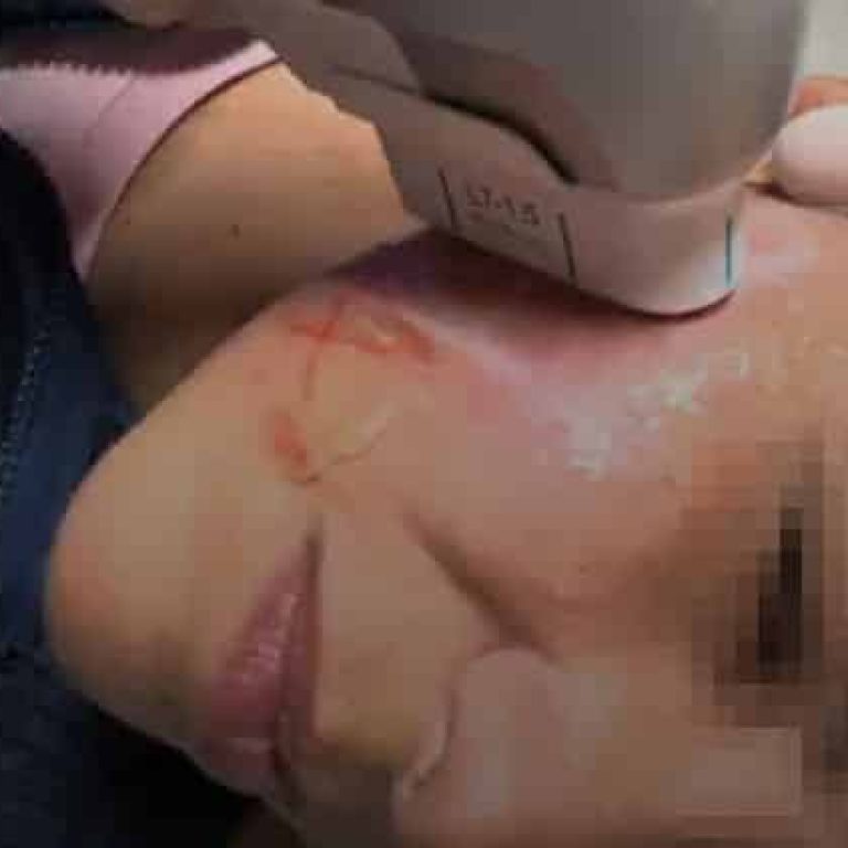 Tratamiento de HIFU facial en una paciente, mostrando el dispositivo en la piel del rostro.