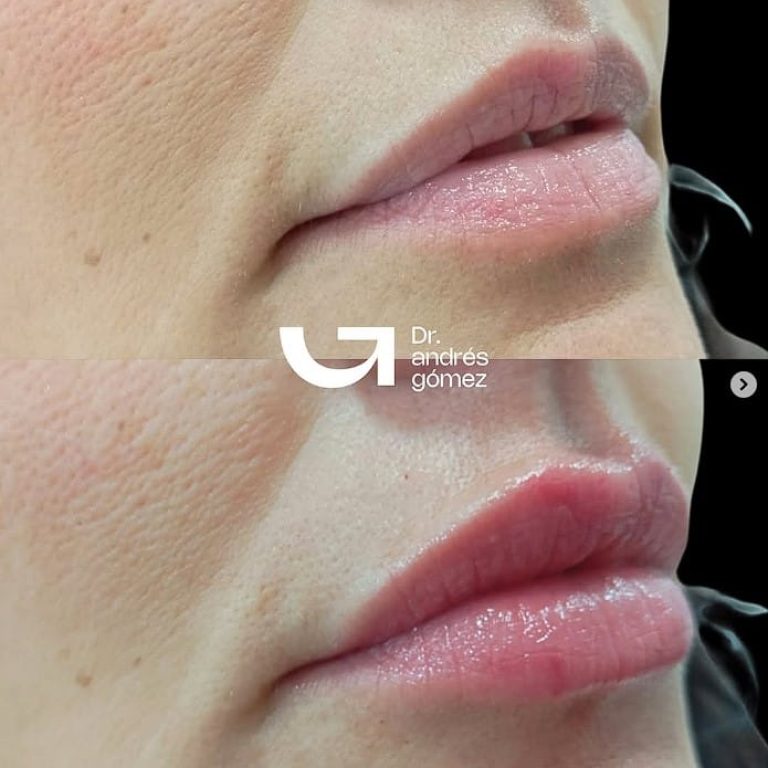 Hidratación de labios sin aumento: labios saludables y naturales