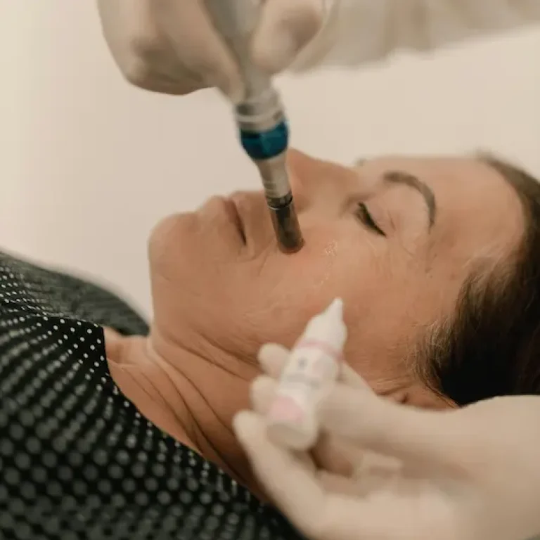 Tratamiento facial con microaguja en paciente, enfocando la aplicación de suero en la piel.