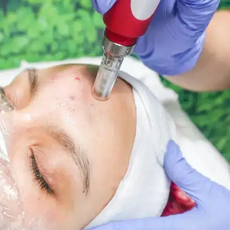 Tratamiento de microaguja en piel de rostro, aplicando serum en una sesión de rejuvenecimiento facial.