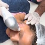 ¿Qué es HIFU? Descubre este Tratamiento Estético Revolucionario