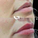 Hidratación de labios sin aumento: labios saludables y naturales