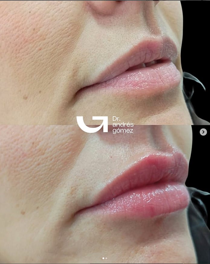 ¿Cómo quitar ácido hialurónico de los labios?