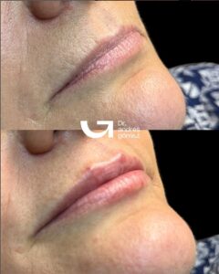 hidratación de labios