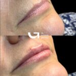 ¿Cuánto Tiempo Dura el Ácido Hialurónico en los Labios?