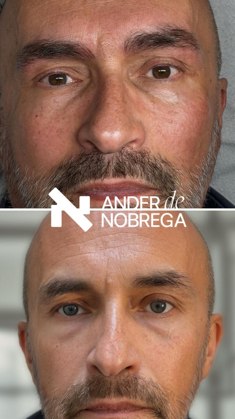 Micropigmentación masculina en Madrid diseñada para realzar tu imagen sin que nadie note el cambio. Resultados naturales, elegantes y adaptados a tu estilo.