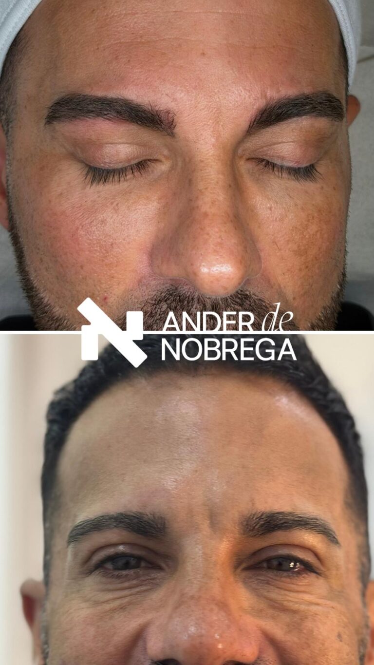 ¿Labios sin color o cejas poco definidas? La micropigmentación masculina en Madrid corrige, equilibra y mejora tu rostro de forma sutil y efectiva.