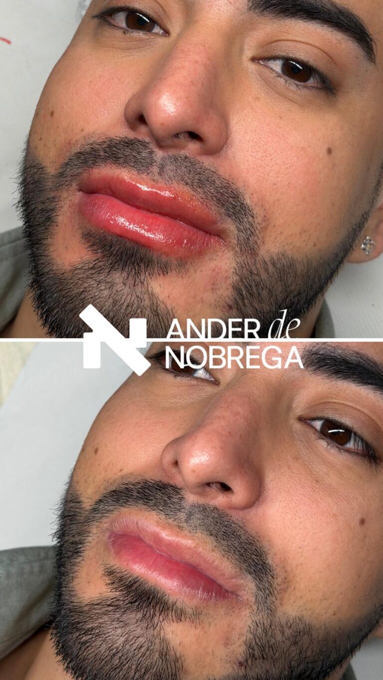 Micropigmentación para hombres en Madrid con enfoque personalizado y resultados de alta gama. Mejora tu imagen con un acabado sofisticado y natural.
