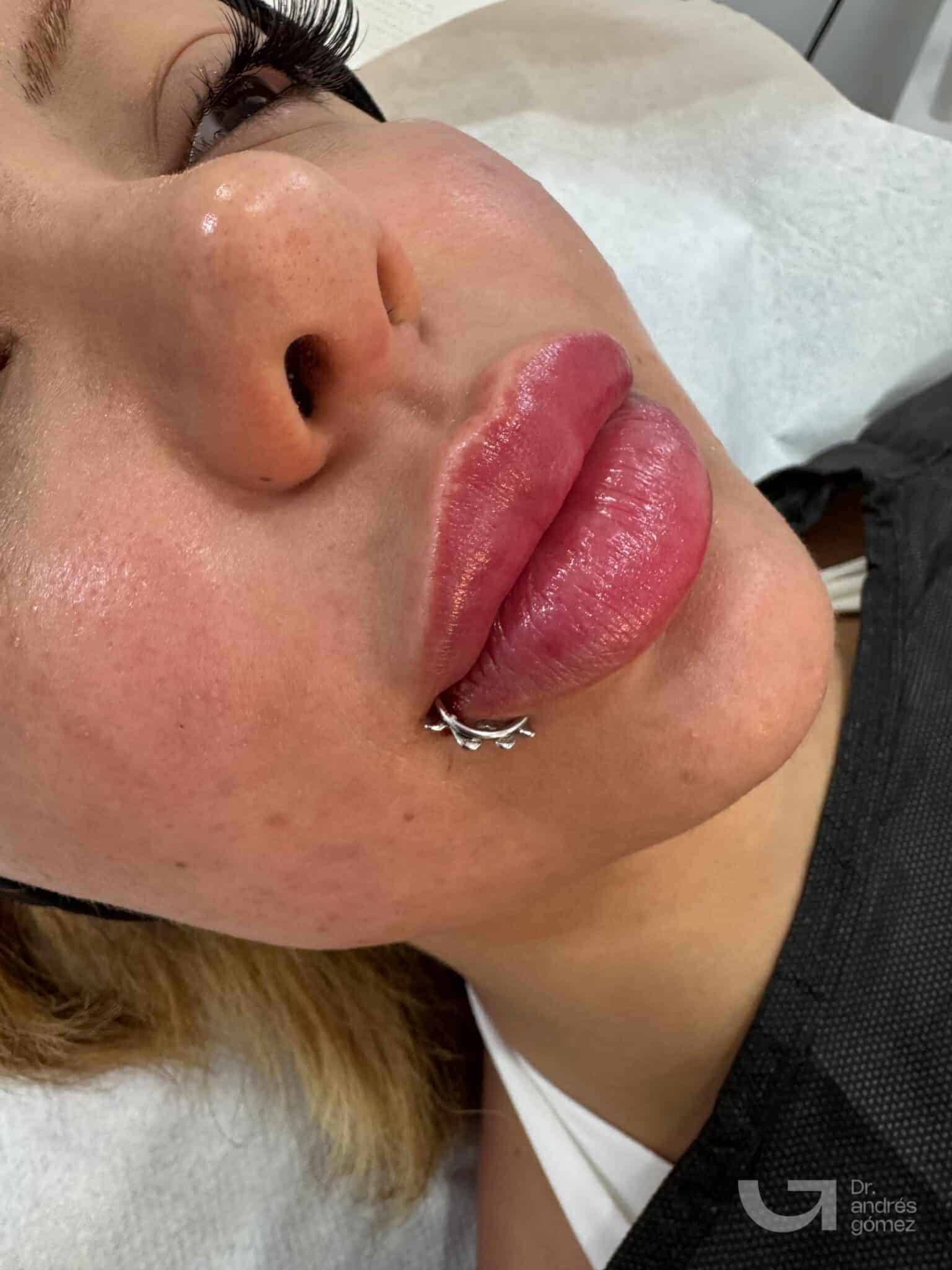 Resultado Russian Lips Clínica Holivine Madrid