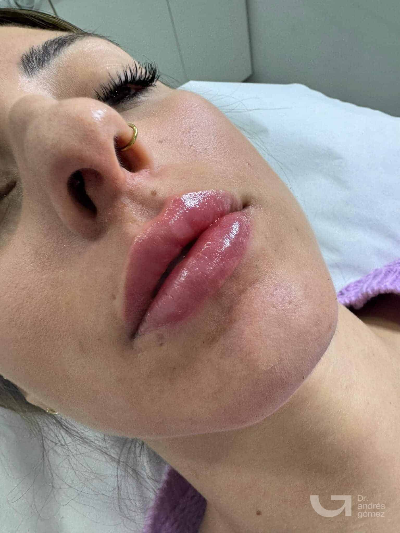 Resultado perfilado labial ácido hialurónico Madrid