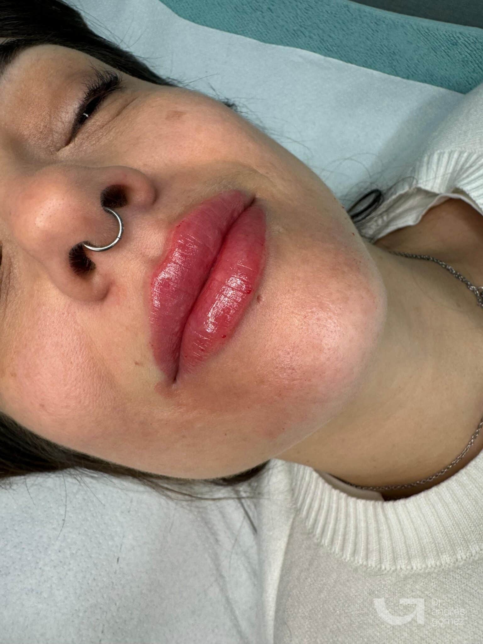 Resultado aumento volumen labios Holivine Madrid