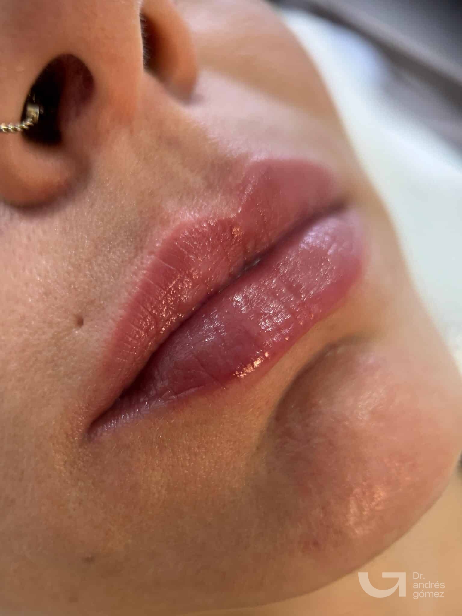 Resultado Russian Lips Dr. Andrés Gómez Madrid