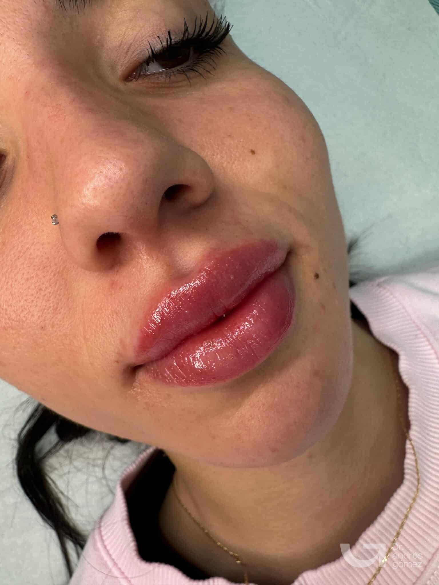 Resultado aumento labios Dr. Andrés Gómez Madrid