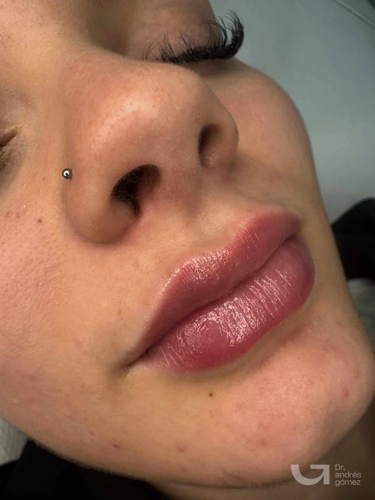 Resultado perfilado volumen labios Madrid