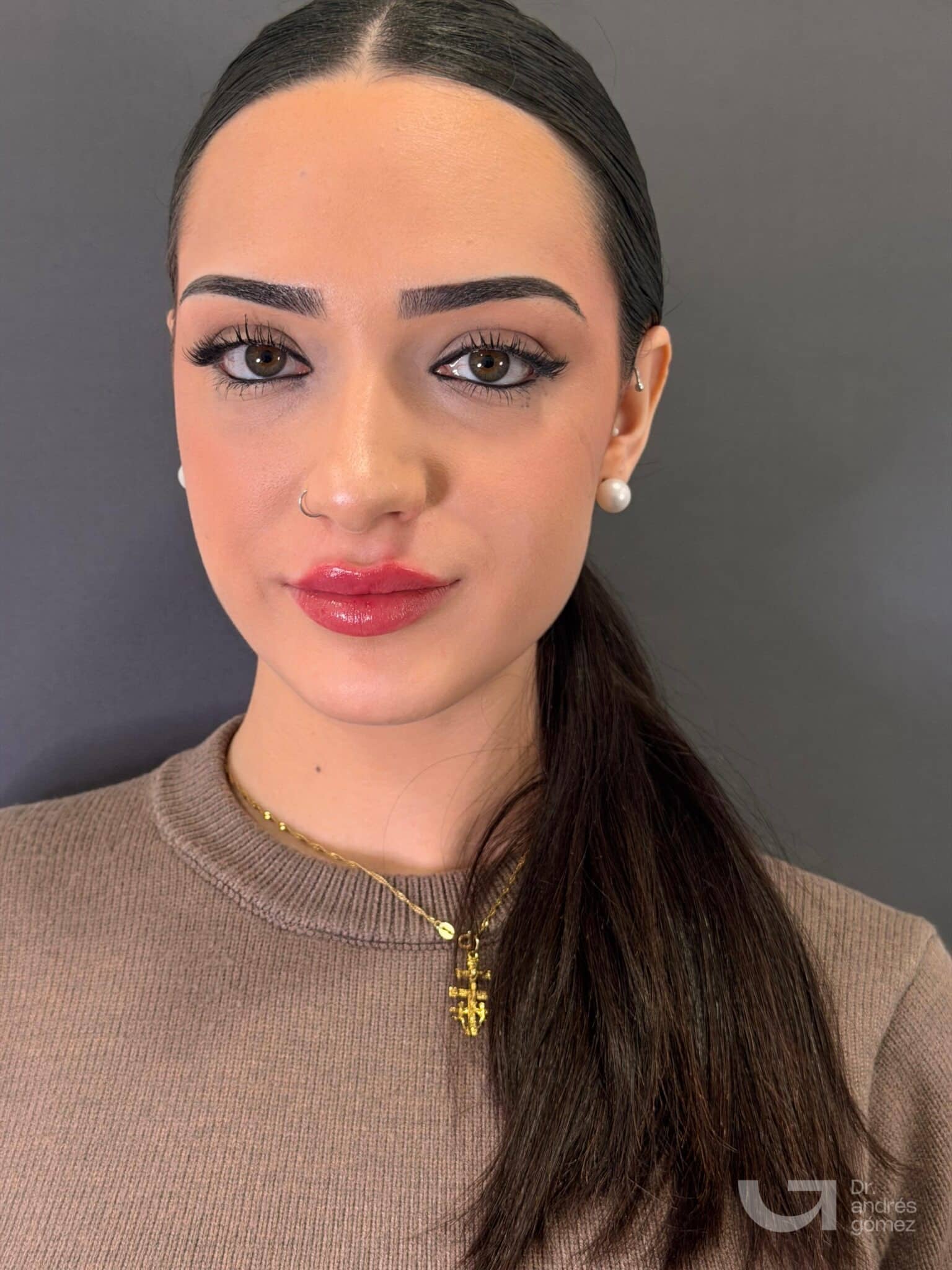 Resultado aumento de labios Clínica Holivine Madrid